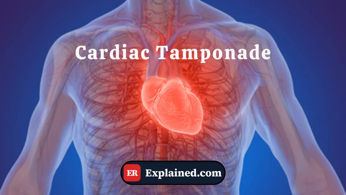 Cardiac Tamponade: What It Is and Why It Is an Absolute Emergency