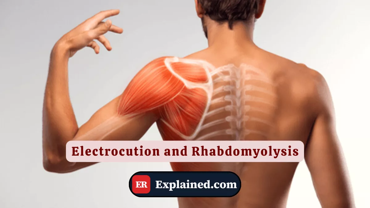 Electrocution and Rhabdomyolysis: The Shock That Melts Muscles