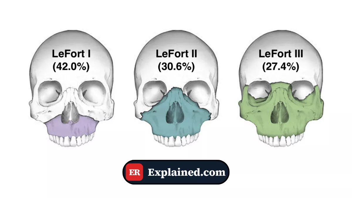 Maxillofacial Trauma Understanding Le Fort Fractures — Clinical Emergency Care | The Pitt TV Series | ER Explained.com