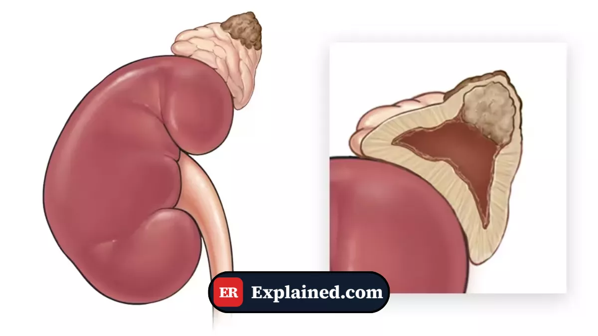 Pheochromocytoma: The Tumor That Fires Adrenaline