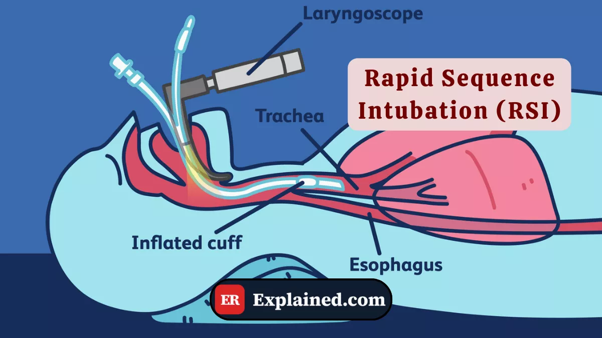 Rapid Sequence Intubation (RSI): The Standard Protocol for Emergency Airways